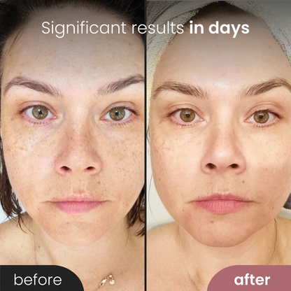 Glow™ Light Rejuvenation